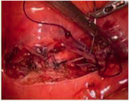 Figure 2. Laparoscopic excision and suture of scar diverticulum.