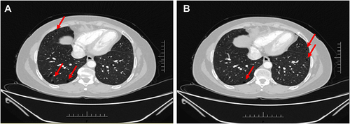 Figure 5 Multiple thin-walled cysts in both lungs on different sections of CT (A and B), which were 10–30 mm in size, rounded, and devoid of internal structure. The red arrows indicate the locations of cysts.