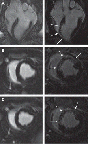 Figure 6. LGE images from one animal at one hour (left) and 7–8 weeks (right) after microembolization, A: horizontal long axis, B and C: short-axis. There are no detectable microinfarcts on LGE at one hour but at 7–8 weeks they were clearly visualized as areas of differential enhancement (arrows). The microinfarcts are patchy with interspersed viable myocardium, distributed in the transmural extent of the myocardium and show stripes or tongues of scarred tissue from the epicardium to the endocardium.