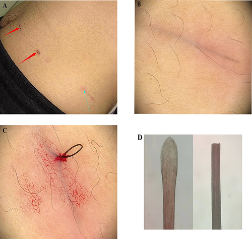 Figure 1 The presentations of ingrowing hair. The anterior abdominal shows pigmentation after carbon dioxide laser treatment (red arrow); a 4-cm-long black linear lesion beneath the skin located on the left lower abdomen associated with inflammatory erythema around (blue arrow) (A). The dermoscopy shows a black line under the skin without vasodilation (×20, polarized light) (B). A hair is pulled out with the association of bleeding by the forceps (C). The microscope shows a hair shaft with follicles (D).