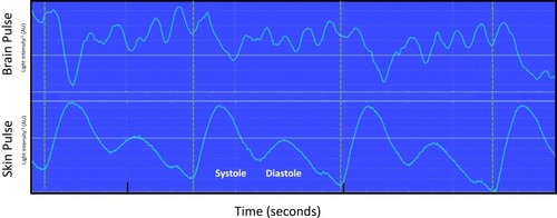 Figure 5 Simultaneous recording of brain and conventional skin pulse oximetry waveforms during a period of raised intracranial pressure (>40 mmHg) following an injection of blood deep into the brain of an animal. Dashed lines mark the start of each skin pulse. The brain oximeter pulse waveform demonstrated a high-frequency oscillation (~7 Hz). These oscillations were not present in the skin pulse. Oscillations at this frequency in intracranial pressure recordings have been documented and represent movement or “ringing” of the brain in response to the systolic pressure wave entering the brain.