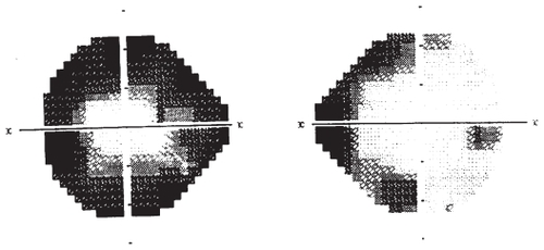 Figure 2 Humphrey visual field map of a patient treated with vigabatrin (VGB). While the visual field defect in patients treated with VGB is typically similar in both eyes, in this patient, the right eye has restriction of the nasal field, while the left eye is more severely affected, demonstrating concentric restriction.