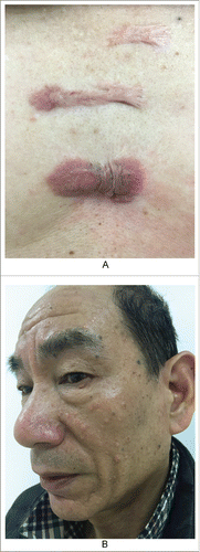 Figure 6. Patient showing keloid and sebaceous gland hyperlplasia. A. The keloids in his chest for 20 years. B. Multiple sebaceous gland hyperplasia in his face.