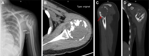 Figure 1 X-ray and CT images of the patient. (A) Preoperative X-ray of this patient showed that there was lytic destruction within the left proximal humerus, mixed with coarse trabeculation and sclerotic margin; (B) Cross section of the CT image showed cortical destruction without periosteal reaction; (C) CT image showed a lytic lesion with sclerotic margin (arrow); and (D) CT image showed coarse trabeculation within the lesion.