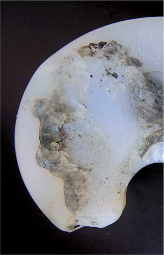 Figure 3. Delaminated UHMWPE knee component after revision surgery due to pain and instability.