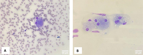 Figure 2 Both panels (A and B) are bone marrow smears showing large cells (macrophages) with multiple hyperchromatic eccentric and nuclei with abundant bluish cytoplasm (Gaucher cells) (X400, Giemsa stain).