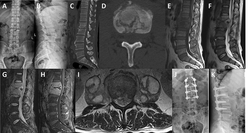 Figure 1 Typical cases of perioperative triple chemotherapy. Preoperative X-ray: intervertebral space stenosis of L1/2 and hyperosteogeny at the anterior edge of the vertebral body, formation of beak-like spur (A and B); preoperative CT: intervertebral space of L1/2 is narrow and there is bone destruction of adjacent vertebral body, “lace vertebra” was formed (C and D); preoperative MRI: inflammatory destruction of L1/2 and adjacent vertebrae, formation of inflammatory tissue in spinal canal, inflammatory tissue of psoas major muscle and paraspinal inflammatory tissue, and compression of posterior dural sac and nerve root by inflammatory tissue in spinal canal (E–I); X-ray immediately postoperatively: internal fixation system firmly in place (J and K).