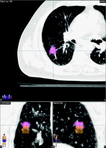 Figure 2.  Two-phase planning target volumes based on contouring of the end-inspiration (yellow) and end-expiration (pink) phase bins of the 4DCT for a tumor showing predominantly cranio-caudal mobility.