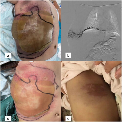 Figure 2. The lesion on the right abdominal wall of a 4-month-old boy.a: Lesions in the right abdominal wall. The inner ring showed the range of lesions in the first day of hospitalization, and the outer ring showed the range of lesions in the 2nd day of hospitalization. b: One of feeding vessels of the lesion, tortuous intercostal artery. c: The swelling was alleviated 1 week after TACE. d: The tumour was completely absorbed and a little pigment deposition was remained 6 months after TACE.