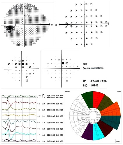 Figure 10 A SITA standard 24-2 test and mfVEP test with HSA printout for a glaucoma patient with a moderate glaucomatous visual field defect.