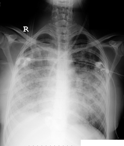 Figure 1. Bilateral alveolar infiltrates compatible with alveolar hemorrhage due to Goodpasture syndrome.