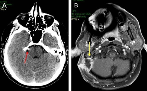 Figure 1 Postoperative CT scan of a 40-year-old man submitted to MVD for right TN (A; red arrow). Brain axial MRI after gadolinium administration (B) 2 months after MVD, showing an abscess at the site of operation (yellow arrow).