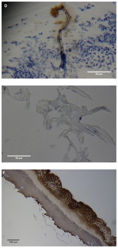 Figure 2 (A) Filament cross, oblique, and lateral sections, from a specimen collected from patient 1 showing round, elliptical/elongated, bean-like, or curved morphology. Note the hollow medulla and surrounding cortex. Cytokeratin (CK) AE1/AE3 staining. 100× magnification. (B) Specimen from patient 1, demonstrating irregular, patchy keratin staining with CK AE1/AE3, longitudinal section. Note most filaments staining positive for keratin (dark brown). 100× magnification. (C) Specimen from patient 1, demonstrating irregular, patchy keratin staining with CK AE1/AE3. Cross, oblique, and longitudinal sections. Note most filaments staining negatively for keratin. 400× magnification. (D) Longitudinal section of filament from patient 1. Note retained nuclei, central medulla, and patchy keratin staining with CK AE1/AE3. 400× magnification. (E) Sectioned filament from a specimen from patient 1, which upon gross microscopic examination demonstrated floral-like or stellate formations. Note retained nuclei within tentacle-like filaments with tapered ends. CK AE1/AE3 staining. 400× magnification. (F) Sectioned callus from patient 1, showing filaments stemming from the stratum basale with evolution inwards towards the dermis. Note filament sections with hollow medulla alongside the stratum basale. CK AE1/AE3 staining. 100× magnification. (G) Gömöri trichrome collagen-positive section of activated fibroblasts with filamentous inclusions from patient 2. Collagen stains green, keratin stains red. Growth of filaments was upwards toward the external surface. 400× magnification. (H) Ruptured keratin projection from both external and internal surfaces from a specimen collected from patient 2, with areas of fibroblast proliferation stained green. Gömöri trichrome stain. 100× magnification. (I) Section from patient 2 stained with Gömöri trichrome, demonstrating both keratin (red) and collagen (green) filament cross-sections, with most filaments associated with the external callus surface. 100× magnification. (J) Gömöri trichrome stain of specimen from patient 2, demonstrating filaments in longitudinal, oblique, and cross-sections close to and within collagen-positive fibroblast collections (green). Note presence of filament cross-sections staining positively for keratin (red). 400× magnification. (K) Bovine digital dermatitis (BDD) filament, longitudinal section, showing positive CK AE1/AE3 staining. 100× magnification. (L) BDD filament, longitudinal section, showing negative CK AE5/AE6 staining. 100× magnification.