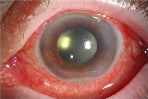 Figure 1 External photograph, left eye, demonstrating acute-onset postoperative endophthalmitis following cataract surgery.