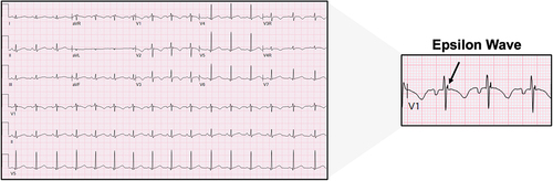 Figure 3 Electrocardiogram from an RVD-AC patient found to have an Epsilon wave in lead V1 and denoted by the black arrow.