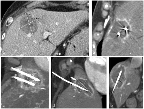 Figure 7. 74 year old woman, with liver recurrence of breast cancer of 36 x 36 mm(a). (b) The lesion was treated with simultaneous activation of two PR antennas; single treatment with a power of 65 W for 10 min was performed. (c, d, e) MIP and MRP reconstructions of the immediate post-procedural CT showing an ellipsoid ablative zone of 60 x 43 x60 mm with complete devascularization.