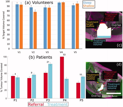 Figure 7. Percentage of target volume covered. (a) For volunteers, the agreement between the referral and treatment covered volumes is shown, where the treatment covered volume is the ground-truth. (b) For patients, the percentage of the registeredreferral tumor (red) and the treatment tumor (blue) that was covered is shown. The numbers on top of each set of bars represent the difference in % Tumor Volume Covered predicted from the registered-referral dataset, and that calculated from treatment dataset. Representative examples of target coverage for volunteers (c) and tumor coverage for patients (d) are shown, with a scale bar in (d). The anatomy is shaded purple in the registered-referral dataset, and green in the treatment dataset.