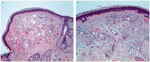 Figure 2. Histopathology of a cherry angioma on the scalp (a) and on the trunk (b) showing dilated vascular channels fully filled with erythrocytes and scant intervening stroma. The epidermis is thinned and surrounds the angioma as a collarette in (a) (hematoxylin-eosin stain, original magnification ×10 (a), ×10 (b)).