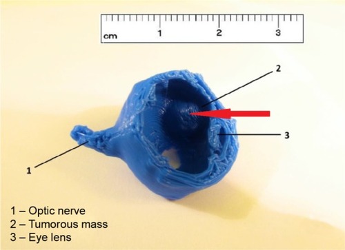 Figure 4 Printed 3D model of the eye with intraocular uveal melanoma, middle-stage T2; arrow indicates tumor mass.