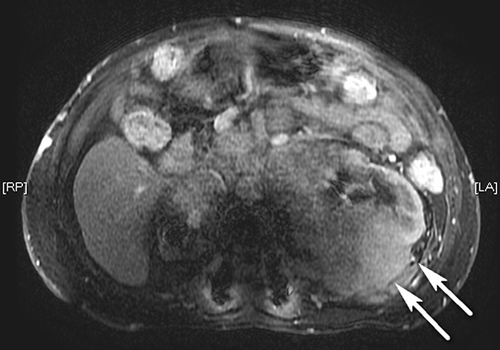 Figure 1. MR image of the mass lesions indiscernible from the kidney around the left renal hilus and the posterior region of the kidney (arrows) (transverse view).Note: MR, magnetic resonance.