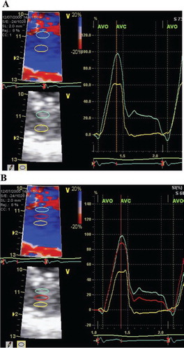 Figure 1. Radial strain in the inferior left ventricular wall.Panel A: Two-layer-measurement. To the left, zoomed image with region of interest 3*6 mm and strain length 2 mm. To the right, strain curve through one heart cycle, with ECG at the bottom. AVO = aortic valve opening. AVC = aortic valve closure. Panel B: Three-layer-measurement. Region of interest 2*6 mm. Otherwise as for panel A.