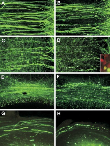 Figure 1 Fluorescence microscopy showing dendrites (A and B) and axons (C and D) of layer V pyramidal neurons in the cerebral cortex of mock-infected (A and C) and moribund challenge virus standard-infected (B, D, and D inset) yellow fluorescent protein mice.Citation43 In infected mice, beading is observed in a minority of dendrites (B), and more axons are involved (D). There are no abnormalities in the dendrites (A) or axons (C) of mock-infected mice. Axons in mock-infected mice are slightly varicosed (C), which is characteristic of these fibers. Fluorescence microscopy shows rabies virus antigen (red) in the perikaryon and dendrite of a yellow fluorescent protein-expressing neuron (D inset). Morphology of the cerebellar mossy fibers of mock-infected (E) and moribund challenge virus standard-infected yellow fluorescent protein mice (F). Mossy fiber axons in the cerebellar commissure of moribund mice show severe beading (F), whereas no abnormalities were observed in mock-infected mice (E). Axons in the inferior cerebellar peduncles are normal in mock-infected mice (G) and show marked beading in challenge virus standard-infected moribund mice (H). A–D) ×230; D) inset, ×220; E, F) ×80; G, H) ×350.Copyright © 2010, American Society for Microbiology. Adapted with permission from Scott CA, Rossiter JP, Andrew RD, Jackson AC. Structural abnormalities in neurons are sufficient to explain the clinical disease and fatal outcome in experimental rabies in yellow fluorescent protein-expressing transgenic mice. J Virol. 2008;82:513–521.Citation43