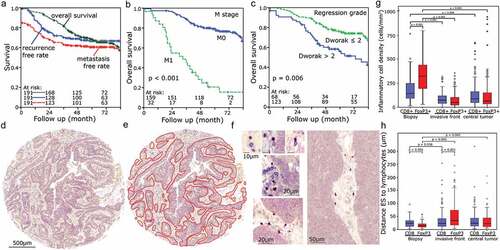 Figure 1. Clinical characteristics of the cohort and TMA samples: (a) Kaplan Meier plots of overall survival, recurrence-free survival and metastasis-free survival in the cohort. (b) Distant metastasis and overall survival. (c) Regression grade (Dworak) and overall survival. Tissue samples were processed into microarrays with a core diameter of 2 mm. (d) Here, an example of tissue derived from the center of a tumor is depicted. (e) The epithelial compartment of the tumor was marked manually using Biomas software. (f) Examples of CD8+ and FoxP3+ T-cells; TIL in proximity to the ESI. (g) Density of stromal TILs in different compartments. (h) Distances of ESI to TIL in different stromal compartments