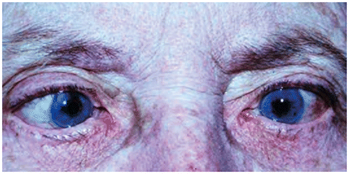 Figure 7b: Incomitance in a patient with a left sixth nerve palsy. On looking to the left, a large-angle squint is apparent