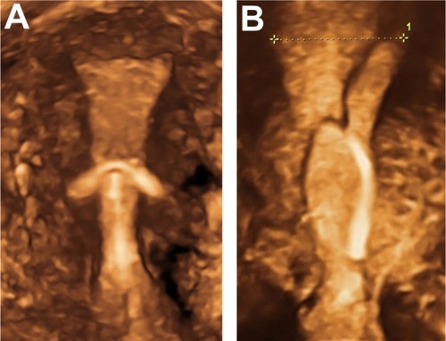 Figure 6 3D ultrasonography of an abnormally located ParaGard® intrauterine device (left) and Mirena® levonorgestrel intrauterine system (right) causing bleeding and pain.