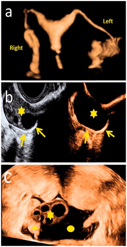 Figure 1. 4-dimensional HyCoSy using SonoVue: (a) Both the fallopian tube and uterus were clearly visible. (b) contrast agent ringlike diffusion (arrow) around the ovary (asterisks). (c) the fallopian tubes (triangle) located on the side of ovary (asterisks) and the fluid collection (round) was an indirect sign of tubal patency.