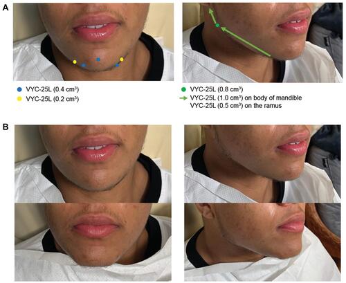 Figure 5 Female-to-male jawline and chin enhancement in a 19-year-old patient who received VYC-25L. (A) Colored dots and arrows indicate injection sites with corresponding concentrations of filler injected. (B) The patient before (top) and immediately after (bottom) treatment. Photographs were taken immediately following treatment. Patient images provided by Vincent Wong, MD.