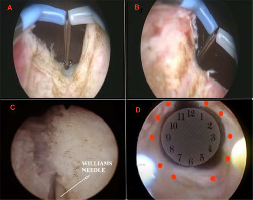 Figure 3 Intraoperative images. (A) and (B) BNC incisions. (C) Injection of MMC using a Williams needle. (D) Red dots denoting ten sites of injection.