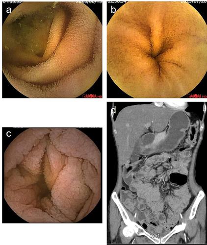 Figure 1 Imaging of normal jejunum (a) and ileum (b) in healthy control under capsule endoscopy. (c) Capsule endoscopy showing mucosa of the jejunum in patient 1, which were congested with blunting of the intestinal villi. (d) CTE of the small intestine in patient 1 showed multiple, slightly enlarged lymph nodes in the peritoneal and mesenteric regions.