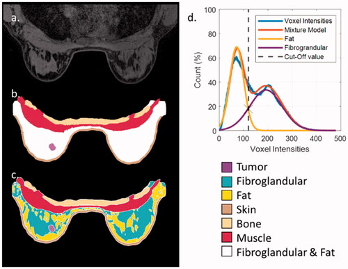 Figure 1. From patient imaging to patient model (patient 10): (a) an axial slice of the patient MRI; (b) the segmentations on the same slice of bone, muscle, skin, tumor, and fibroglandular-fat mixture; (c) the same segmentation on the same slice, with the automated division of the fibroglandular-fat mixture into two distinct tissue entities; (d) the two-component GMM that lead to the selected cutoff value in the fibroglandular and fat mixture.