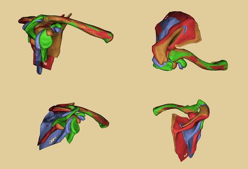 Figure 2 3D images after registration: front view, vertical view, side view, and rear view.
