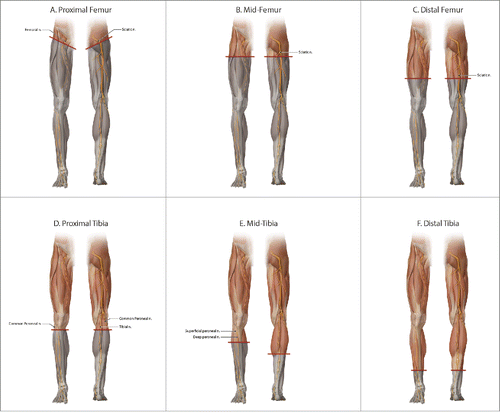 Figure 2. Classification of lower extremity transplantation levels base on preserved recipient muscle innervation: (A) proximal femur with no retained innervation, (B) mid-femur with preserved quadriceps, (C) distal femur with preserved anterior and posterior thigh muscle innervation, but above the knee, (D) proximal tibia is below the knee, but without innervation of any lower leg muscles, (E), mid-tibia is based off typical stair-stepped below knee amputation incisions, with preserved posterior compartment muscles but no anterior compartment innervation, and (F) distal tibia with innervation to all extrinsic muscles of the foot retained.