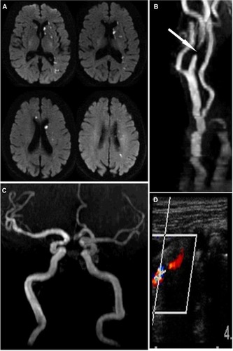Figure 1 Stroke and extracranial carotid atherosclerosis.
