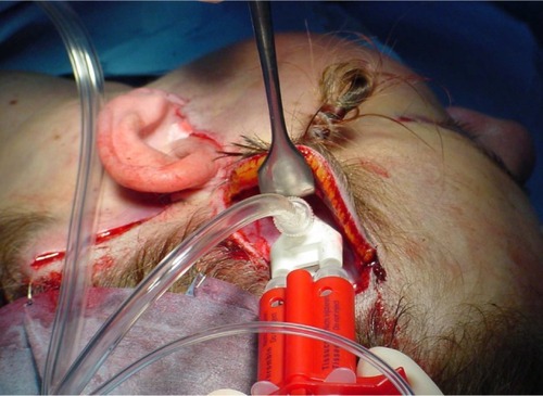 Figure 2 Intraoperative photograph of fibrin glue in dual-jet sprayer being aerosolized under skin flaps and on top of the superficial muscular aponeurotic system. Note that the fibrin sealant is applied after application of key sutures and removal of excess skin.