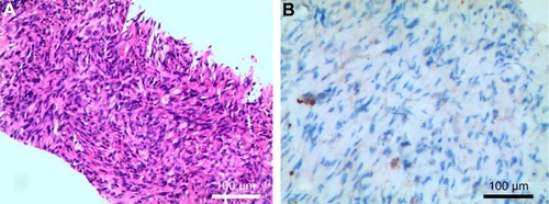 Figure 1 Histopathological and immunohistological findings of the lymph nodes tissues samples. (A) Hematoxylin and eosin staining showed malignant spindle cells (200×), which displayed immunohistochemical positive staining for CK, SMA, CD34, CD99, and Bcl-2, and negative for Des, S-100, and B-Catenin. (B) IHC of our patient did not reveal supported ALK gene mutation (200×).