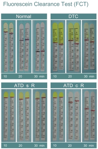 Figure 1 Fluorescein clearance test results. The black line indicates the portion of the strip wetted by tears. 1A: in healthy subjects, the wetting length is ≥3 mm and fluorescein stains only the first strip, whereas the wetted portion increases in the second and third strips. 1B: in case of delayed tear clearance, fluorescein stains all three strips and normal wetting length is observed. 1C: in the event of aqueous tear deficiency without reflex tearing, the wetting length is nearly 0 mm for all 3 strips; 1D: in the event of aqueous tear deficiency with reflex tearing, the wetting length of the first strip is 0 mm and increases especially in the third strip, when nasal stimulation is performed.