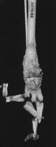 Figure 1. Posterior view of Macaroni penguin (Eudyptes chrysolophus) ankle. Reactive new bone of infectious arthritis.