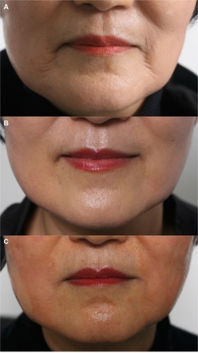 Figure 2 Treatment of marionette lines with diluted RAD using 27G cannula.