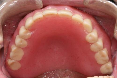 Figure 19 Maxillary denture 10 years after delivery (flipped mirror image).