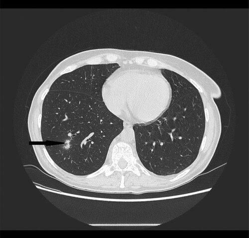 Figure 5. 62-year-old female with acute myeloid leukemia presenting with cough and fever. High resolution CT scan obtained at level of lower lobes shows nodules with halo sign located peripherally in right lower lobe (black narrow arrow).