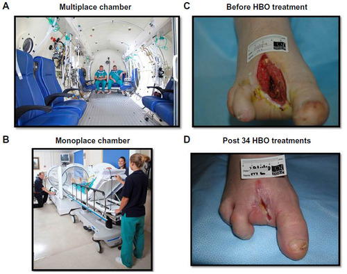 Figure 3 Patient HBO chambers and effect of HBO on components of wound healing. (A and B) Multiplace and monoplace chambers used to treat chronic wounds. (C) Typical type 2 diabetic foot sepsis leading to third digit amputation secondary to osteomyelitis. (D) Effect of a complete course of 36 sessions of HBO therapy over a 2-month period.