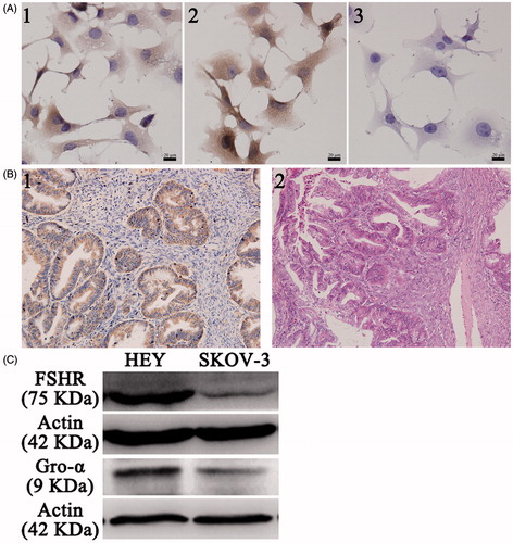 Figure 1. FSHR and gro-α expression in ovarian cancer cells and tissues. (A) FSHR and gro-α expression in ovarian cancer cells by immunocytochemistry. 1, 2 and 3, HEY cells stained with FSHR antibody, gro-α antibody, and negative control. (B) Gro-α expression in human ovarian cancer tissues (200×). 1, gro-α expression; 2, H&E staining. (C) FSHR and gro-α expression in ovarian cancer cells by Western blot.