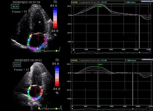 Figure 1 Two-dimensional speckle tracking ultrasound of the left atrium.