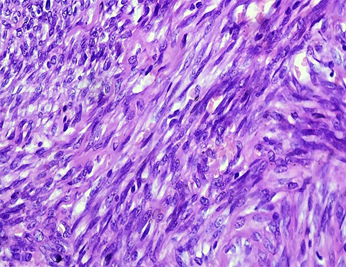 Figure 6 Under 100X magnifications, shows vague interlacing fascicles of hyperchromatic and pleomorphic spindle cells forming vascular slit-like and blood-filled spaces. Accompanying mononuclear inflammatory infiltrates and occasional mitotic figures, including abnormal forms, are seen.