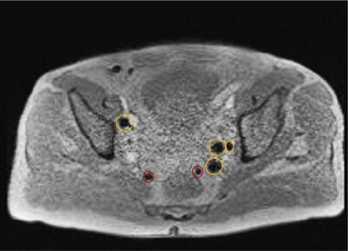 Figure 2 After intraprostatic administration of SPION, multiple SLNs, including the two red marked perirectal nodes showed a strong drop of signal intensity on post-contrast T2*-weighted image.Abbreviations: SLN, sentinel lymph node; SPION, superparamagnetic iron oxide nanoparticles.