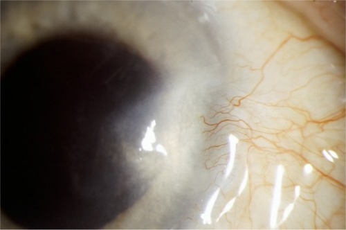 Figure 3 Early pterygium recurrence 2 months after successful surgery.